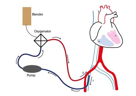 va ecmo vs impella